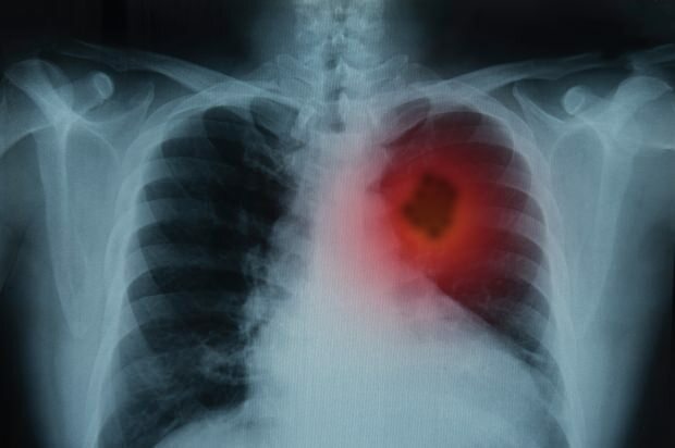 Was sind die Symptome von Lungenkrebs? Gibt es eine Lungenkrebsbehandlung? Um Lungenkrebs vorzubeugen ...