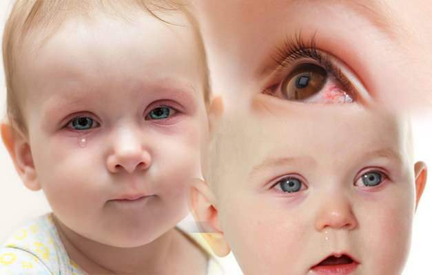 Warum bekommen die Augen von Babys Blut? Wie verlaufen Augenblutungen bei einem Neugeborenen?