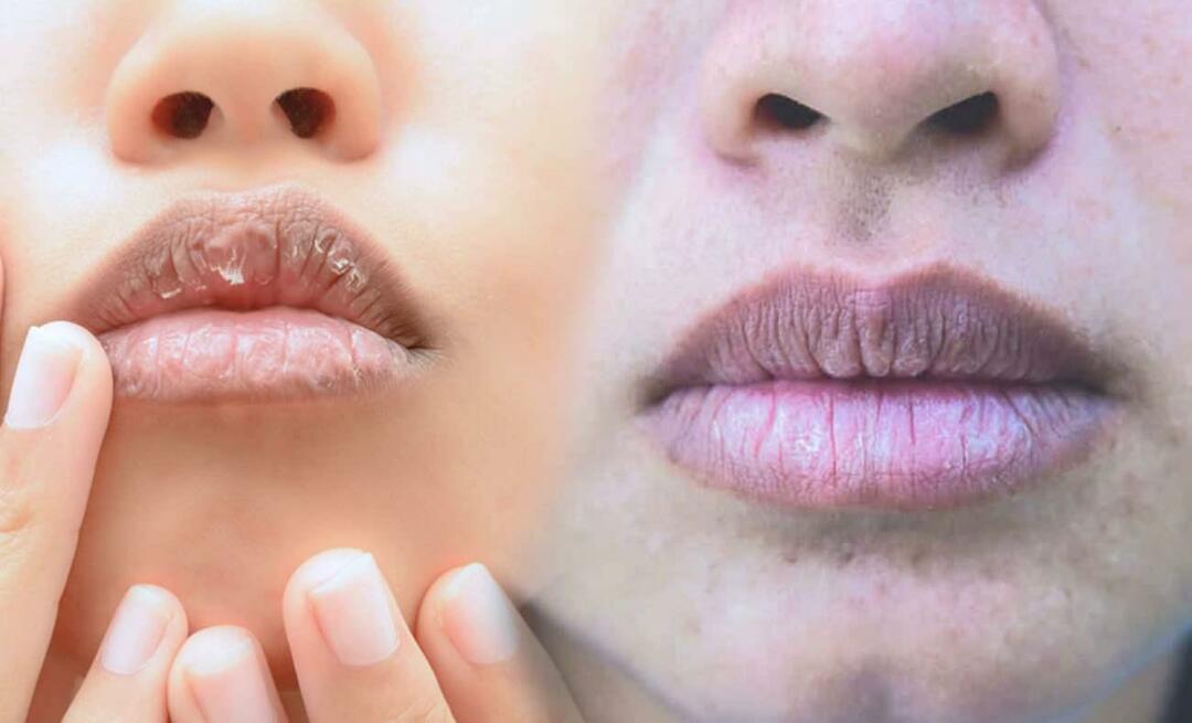 Was verursacht dunkle Lippen? Wie wird Lippenverdunkelung oder Blutergüsse behandelt?