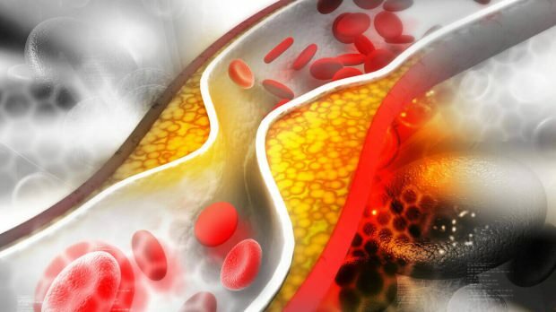 Was sind die Symptome von Cholesterin