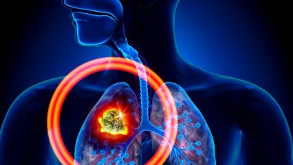 Was sind die Symptome von Lungenkrebs? Gibt es eine Lungenkrebsbehandlung? Um Lungenkrebs vorzubeugen ...