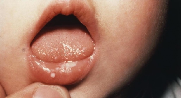 Wie schmerzt ein Mund bei Babys?