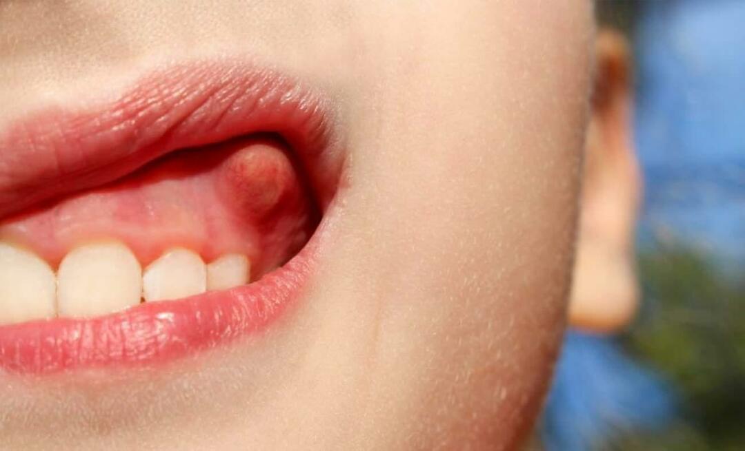 Warum entsteht ein Zahnabszess und was sind die Symptome? Zahnabszess, wie wird er behandelt?