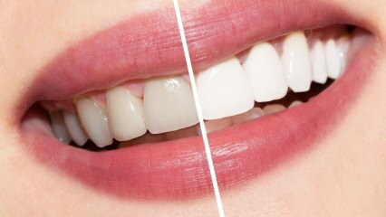 Was sind die Empfehlungen für weiße Zähne? Zahnaufhellung natürlich zu Hause heilen ...