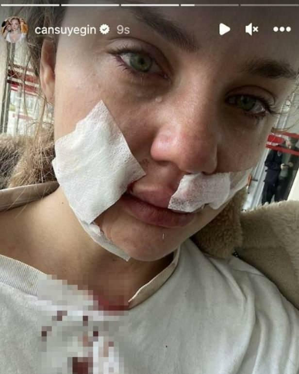 Cansu Yeğin wurde von einem Hund angegriffen