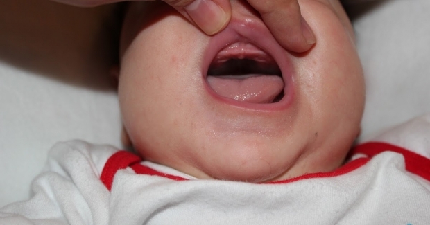 Was ist Gaumentropfen bei Babys, warum? Symptome und Behandlung ...