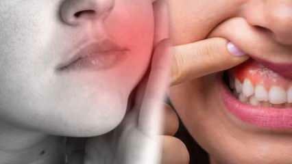 Was verursacht einen Zahnabszess? Was sind die Symptome und in wie vielen Tagen? Natürliche Lösungen gegen Zahnabszesse...