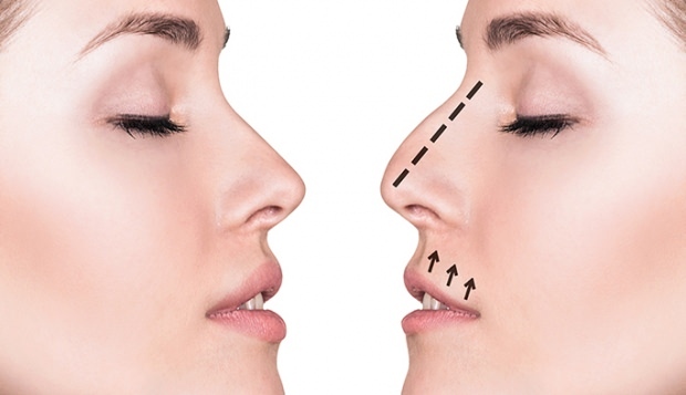 Wie wird eine Nasenoperation durchgeführt? In welchen Fällen wird eine Nasenkorrektur durchgeführt?