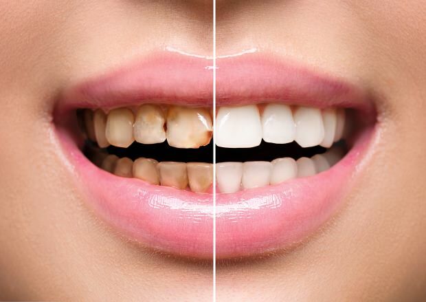 Infolge einer ungesunden Ernährung treten sowohl Zahnverfärbungen als auch Zahnverlust auf