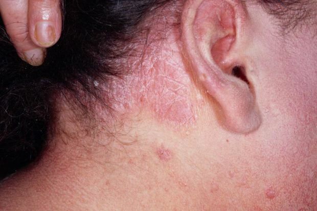 Was sind die Symptome einer seborrhoischen Dermatitis und wer tritt auf? Lebensmittel, die die Krankheit auslösen
