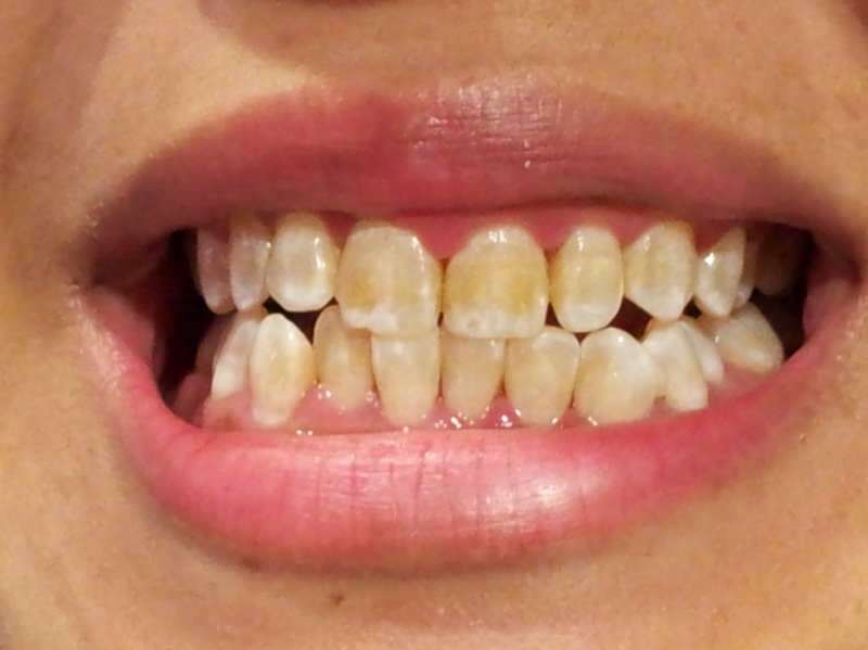 Zahnbild einer Person, deren Zähne sich zu verdunkeln beginnen