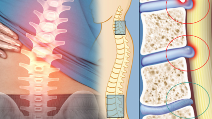 Was ist eine Verengung des Rückenmarks? Was sind die Symptome einer Verengung des Rückenmarks? Gibt es ein Heilmittel gegen die Verengung des Rückenmarks?