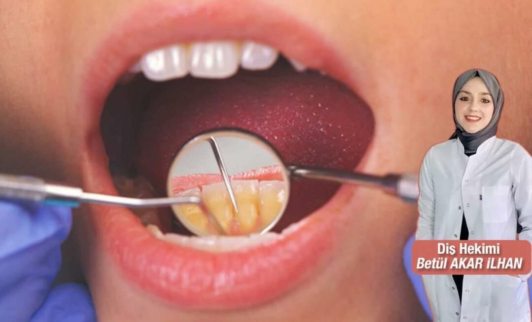 Was ist zu tun, um Zahnstein zu vermeiden? Was sind die Vorteile von Zahnsteinentfernung?