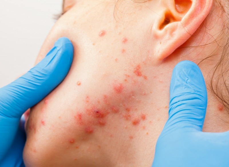 Das Virus verursacht Blasen auf der Hautoberfläche