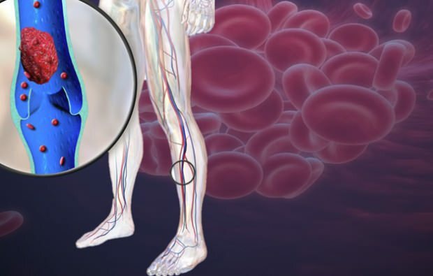 Eine verminderte Durchblutung der Beinvenen verursacht Schmerzen